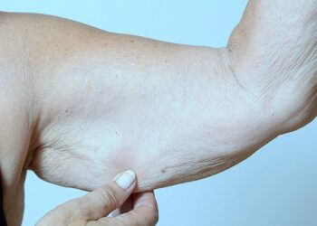 Sarcopenia em idosos