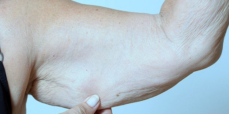 Sarcopenia em idosos