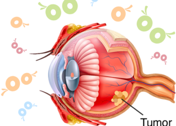 Retinoblastoma em crianças.