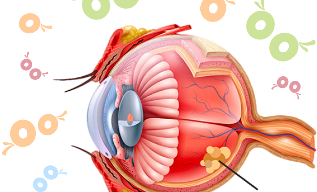 Retinoblastoma em crianças.