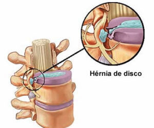 Dúvidas sobre Hérnia discal ?
