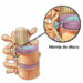 Dúvidas sobre Hérnia discal ?
