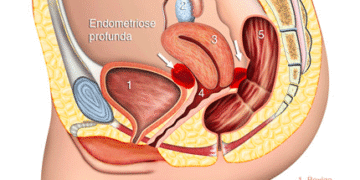Governo investirá R$ 60 milhões em pesquisas para diagnóstico e tratamento da endometriose