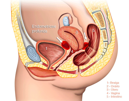 Governo investirá R$ 60 milhões em pesquisas para diagnóstico e tratamento da endometriose